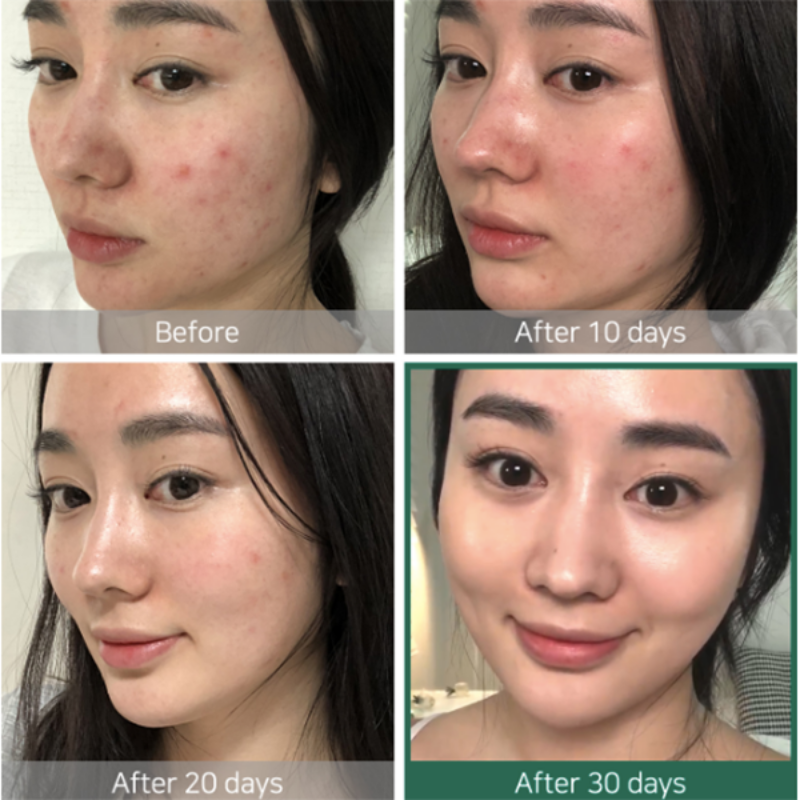 Tónico Exfoliante para Piel Grasa - AHA BHA PHA 30 Days Miracle Toner Somebymi 150ml